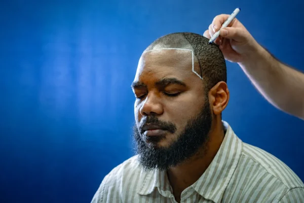 Are You a Good Candidate for Hair Transplantation? Let’s Find Out Together