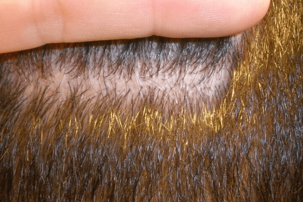 Greffe De Cheveux : Laisse-T-Elle Des Cicatrices Sur La Zone Donneuse ?