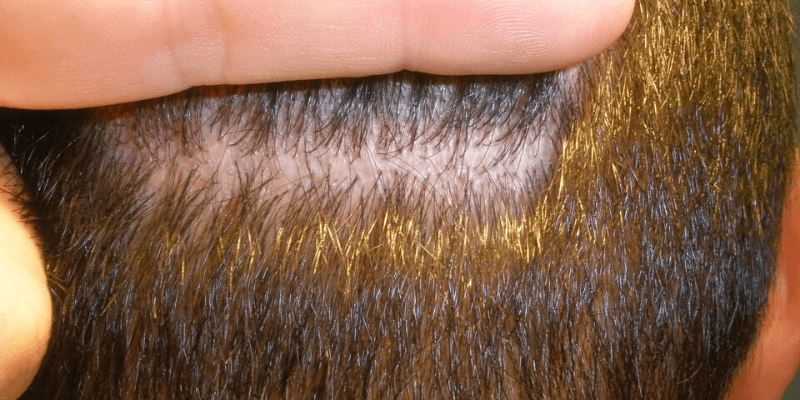 Greffe De Cheveux : Laisse-T-Elle Des Cicatrices Sur La Zone Donneuse ?