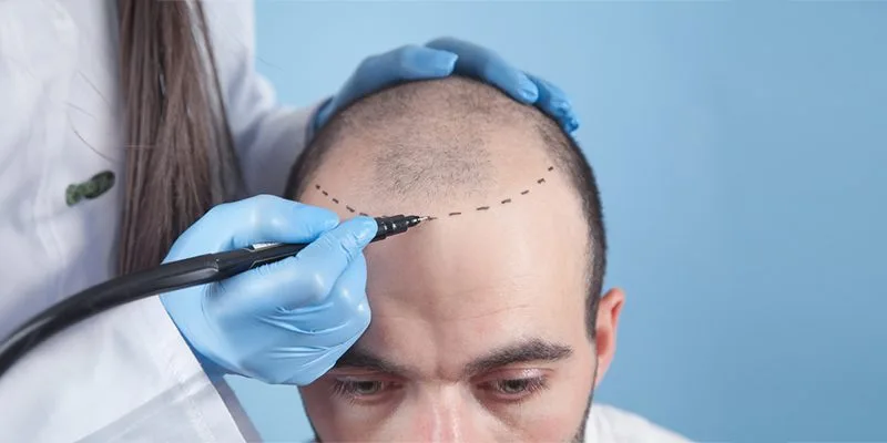 Êtes-vous un bon candidat à la greffe de cheveux ? Découvrons-le ensemble
