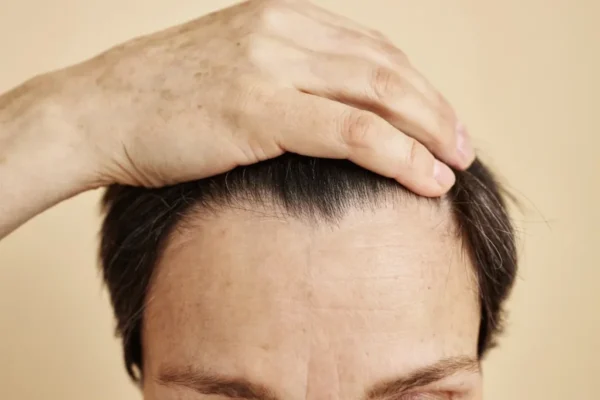 ¿Qué Tan Permanente Es Un Trasplante De Cabello?