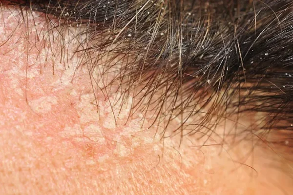 Costras Después Del Trasplante De Cabello: Qué Esperar Y Cómo Cuidarlos