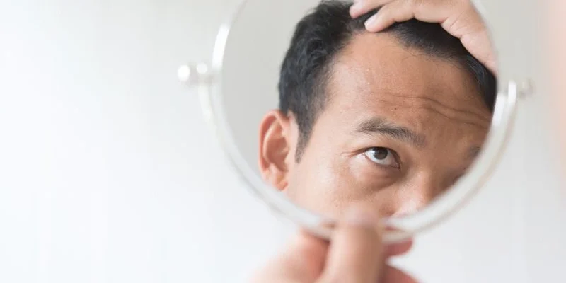 Pourquoi Devrais-Je Me Faire Greffer Des Cheveux En Turquie ?