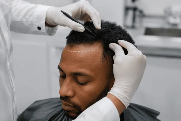 Afro Hair Transplant