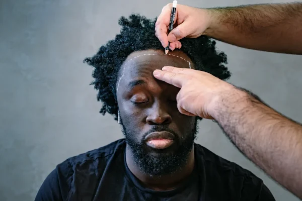 How Does the Afro Hair Transplant Procedure Proceed in Turkey?
