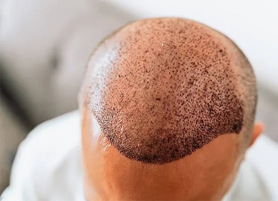 After Hair Transplant
