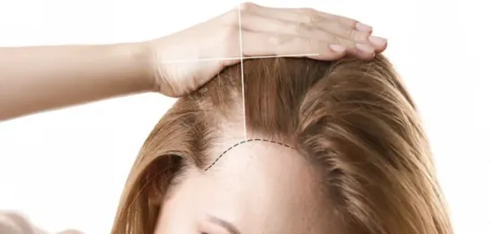 Hair Transplant for Women: A Delicate Art with Life-Changing Results