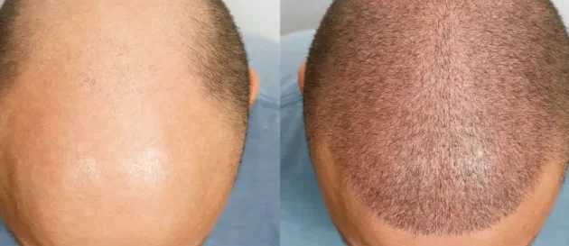 The Top 7 Mistakes You Should Avoid After a Hair Transplant