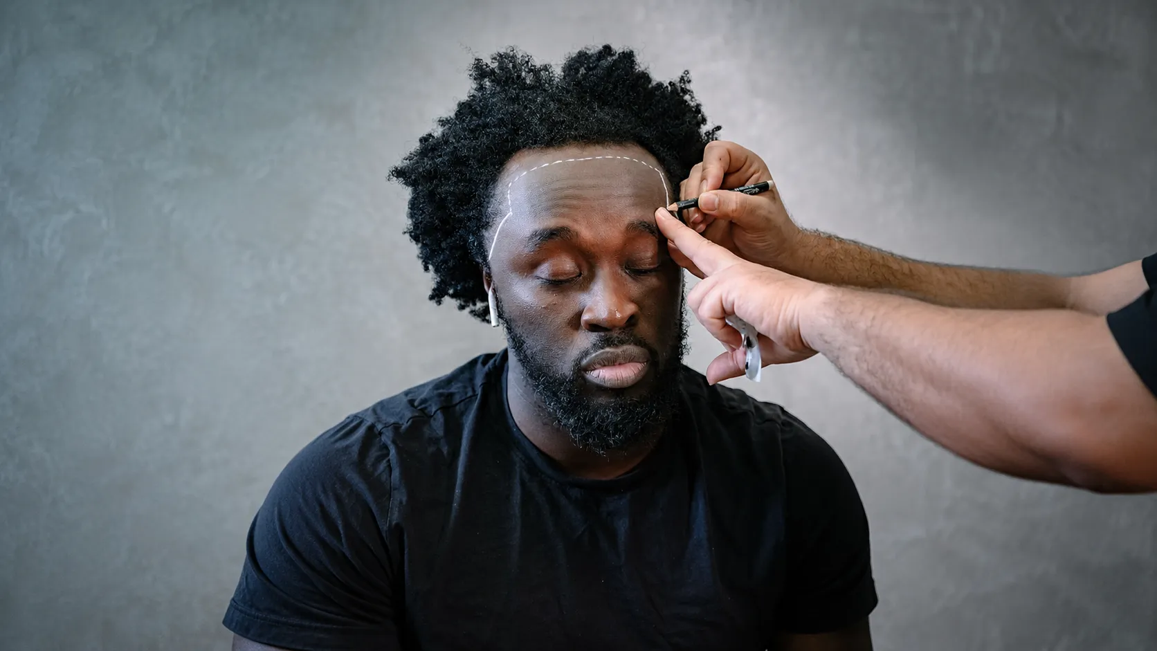 Afro Hair Transplant