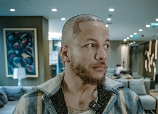 After Hair Transplant