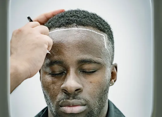 Before Hair Transplant