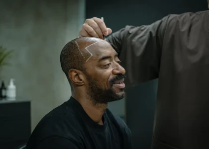 Greffe de cheveux pour hommes