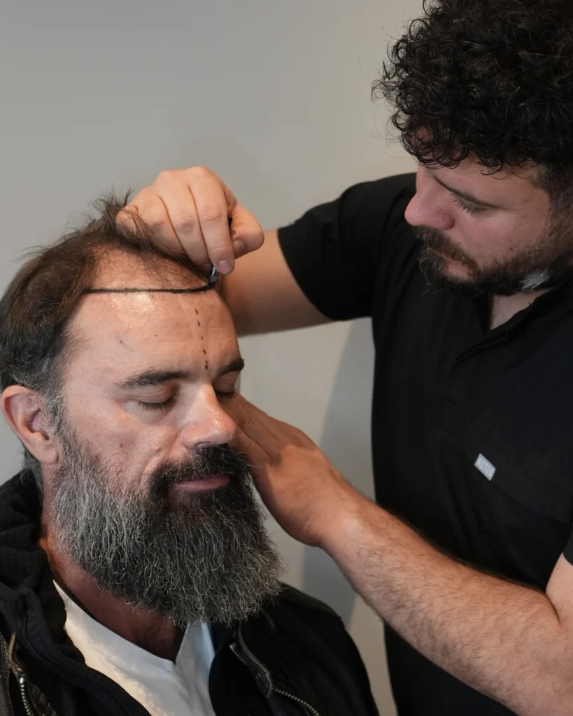 Trasplante capilar para hombres 1 Trasplante capilar para hombres