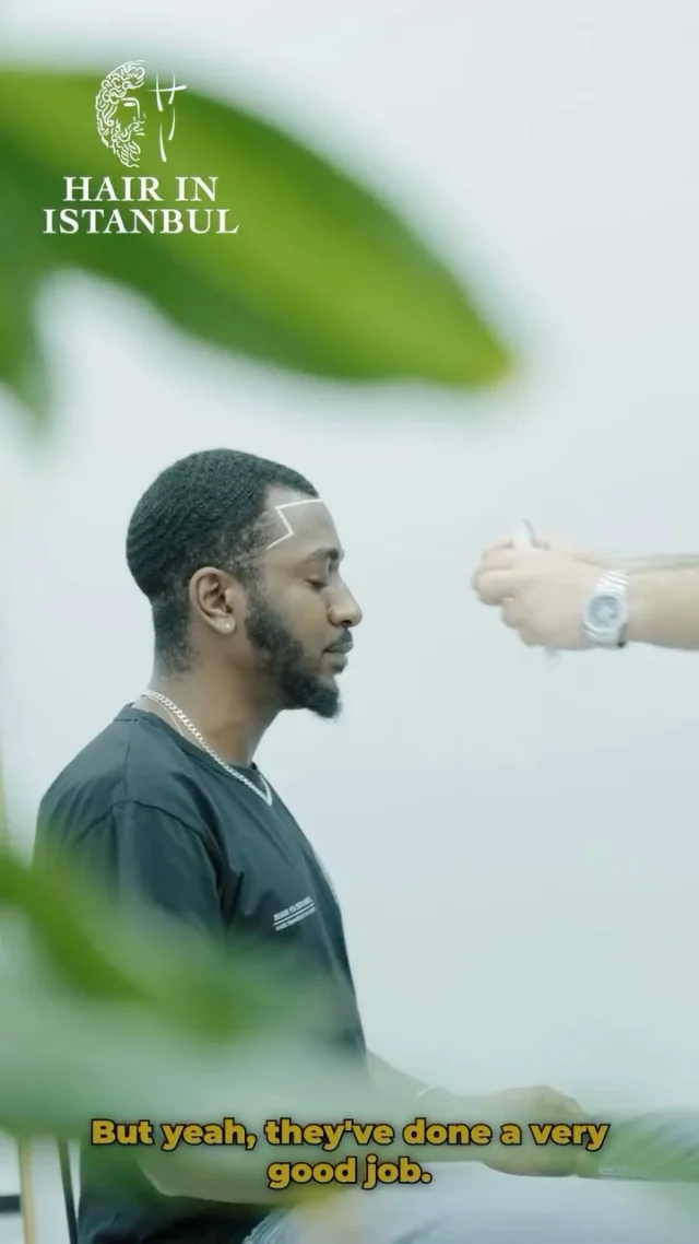 Liam’s Afro Hairline Journey – From the UK to Istanbul 🇬🇧➡️🇹🇷

One concern. One detail. One decision.
Hair in Istanbul.

Liam came to us from the UK with one very clear priority: his front hairline 🎯

For him, it was never about graft numbers.
It was about the most critical and irreversible part of an Afro hair transplant — the Afro hairline.

Liam already knew that Afro hair is not simply “curly hair”.
Under the skin, follicles are naturally curved, extraction angles are different, and the implantation strategy must be fully adapted 🧬

More importantly, Afro facial structure and proportions do not biologically match flat, straight, and perfectly symmetrical hairlines.

That is exactly why Liam chose Hair in Istanbul.

His hairline was not drawn from a template.
It was carefully designed based on Afro facial balance and symmetry, natural recession points for Afro men, Afro-specific density transitions, curl direction and follicle curvature, and long-term visual harmony ✨

At Hair in Istanbul, Liam’s procedure was not treated as a routine operation.
It was planned as a true Afro hairline design case.

During the procedure, Liam clearly felt the difference.

🗣️ “The procedure went well. The doctor showed me and guided me through the whole process and made it seamless.”

Afro hair transplantation is technically demanding.
But Afro hairline design is even more critical ⚠️

One wrong angle, one flat temple line, one copied design — and the natural identity of the Afro hairline can be lost.

Comfort and patient care were also a major part of Liam’s experience.

🙂 “I had almost no pain. I feel great right now.”

Even at this early stage, Liam already feels confident about his decision.

✅ “I’m very happy with the results, even at this point. They’re doing a great job.”

His final message speaks clearly:

📍 “If you’re thinking about coming to Turkey for a hair transplant, come to the Hair in Istanbul clinic.”

#AfroHairTransplant
#AfroHairlineDesign
#BlackMenHairTransplant
#NaturalAfroHairline
#HairInIstanbul