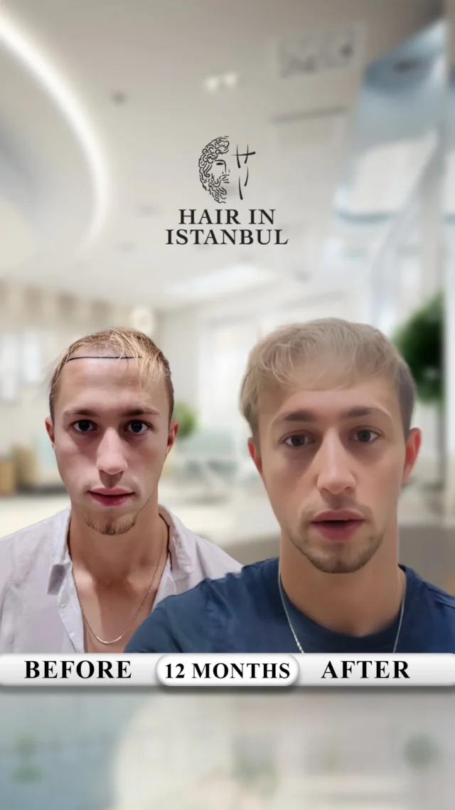 🇩🇪 Born in Germany.
🇺🇸 Living in New York, USA.
🎥 1-Year Hair Transplant Result — In His Own Words

This is William Aslan.
He was born in Germany and currently lives in New York, USA.

And what you’re watching is his real result exactly 1 year after his hair transplant.
Even more powerful?
👉 He’s explaining his own journey and result himself.

But here’s what makes William’s case truly special:

➡️ He started losing his hairline very early — at just 21 years old
➡️ His hair is naturally fine-textured
➡️ Because of this, we needed more grafts to achieve strong, visible density

So what did we do?

✔️ A total of 5,150 grafts transplanted
✔️ Focused on the front + mid-scalp (not the crown)
✔️ The entire front hairline was redesigned personally for his face
✔️ Density was built especially in the front and mid-scalp
✔️ Natural angles, directions, and exits were preserved 100%

Important detail:
👉 This was NOT a crown (vertex) case
👉 This was a front + mid-scalp reconstruction for maximum visual impact

Now look closely:

➡️ Does the hairline look natural?
➡️ Does the density look real and full?
➡️ Does the transplanted hair blend perfectly with his native hair?
➡️ Can you tell where the transplant starts and ends?

That’s the real test.

And this brings us to the most important truth in hair transplantation:

📸 Photos can be edited.
🤖 AI can change everything.
🖌 Photoshop can hide all mistakes.

🎥 But video cannot lie.

Real lighting.
Real angles.
Real density.
Real workmanship.

That’s exactly why we only share video results.

Because real results can only be proven on video.

This isn’t about knowing everything.
It’s about knowing what to look at.

And remembering one simple truth:

👉 Real results are proven on video.

🎥 Real people.
🎥 Real videos.
🎥 Real results.

If you’re thinking about a hair transplant,
don’t focus on promises — focus on proof.

📩 DM us for your personalized consultation.
Let’s plan your transformation — the right way.

#hairtransplant
#afrohairtransplant
#blackhairtransplant
#hairtransplantturkey
#hairinistanbul