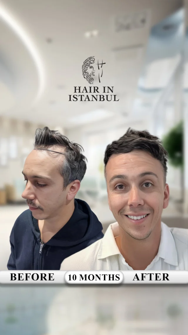 Brody’s 10-Month Hair Journey – From Melbourne to Istanbul 🇦🇺➡️🇹🇷**

Ten months ago, Brody made a decision he’d been thinking about for a long time.
Not just about hair — but about how he wanted to feel when he looked in the mirror.

Coming all the way from Melbourne, he had the same doubts almost everyone has:
🤔 *“Is it actually going to look natural?”*
🤷‍♂️ *“Can I really trust a clinic overseas?”*

But from the very first conversation, he realised something was different.

This wasn’t a factory clinic.
This wasn’t rushed.
And it definitely wasn’t “one-size-fits-all.”

It was a team that actually listened. ❤️

Every step was explained clearly.
Every message was answered.
And even after returning home to Australia, the follow-ups never stopped.

💬 **In Brody’s own words:**
*“I’m honestly so happy with the result. The hairline looks completely natural, the density is exactly what I wanted, and the support from start to finish was amazing. I’d 100% recommend them.”*

Now, 10 months later…
The result speaks for itself.

A natural, age-appropriate hairline.
Strong, even density.
And most importantly — confidence is back. 💪

What makes Brody’s story special isn’t just the hair.
It’s how safe and supported he felt throughout the entire journey.
Even months later, knowing the team is still there if he needs anything.

That’s the difference.

✨ **Why Brody chose Hair in Istanbul — and why so many men around the world do the same:**
✔️ Real communication, not sales talk
✔️ Personal care — only a limited number of patients per day
✔️ Natural results designed for *your* face, *your* age
✔️ 5-star hotel comfort, VIP transfers, and lifetime guarantee

Months later, back home in Melbourne, standing in front of the mirror…
Brody doesn’t just see hair.

He sees the version of himself he missed.

📩 If you’re still thinking about it — that’s your sign.
DM us. Your story could be next. ✈️🇹🇷

#HairInIstanbul
#HairTransplantTurkey
#RealHairResults
#BeforeAfterHair
#HairConfidence