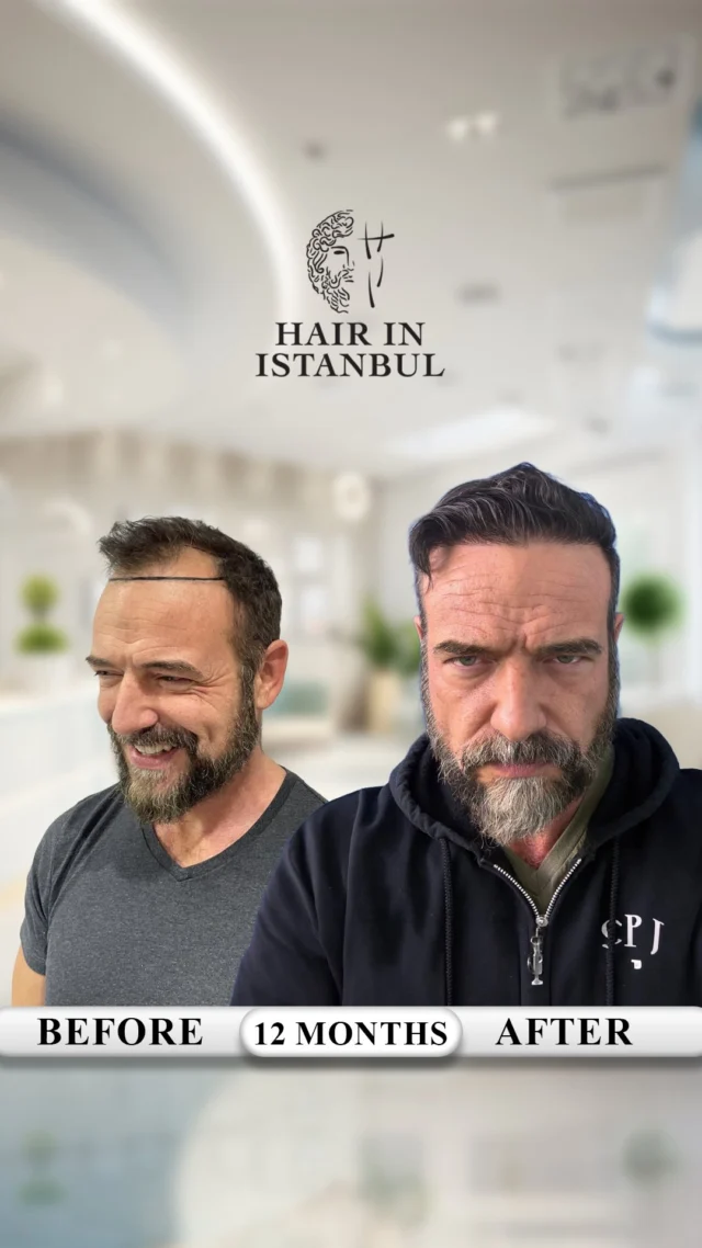 🎥 Real story. Real visit. Real result. — Ed, Canada 🇨🇦

One year after his hair transplant, Ed returned to Istanbul from Canada.

Not for another treatment.
Not for a check-up.

👉 He came back only to visit us again,
👉 and to let people see with their own eyes how natural and strong his result still is after one full year.

Because some results are not just shared…
they are worth coming back for.

Ed had one simple request:
“Don’t show photos. Show the video.”

📸 Photos can be edited.
🤖 AI can change everything.
🎥 But video cannot lie.

Real lighting.
Real angles.
Real density.

That is why, one year later, Ed visited us again —
simply because he was truly happy with his result
and wanted people to see the real proof.

👉 Don’t trust promises. Trust proof.
👉 Don’t trust photos. Trust videos.

#hairtransplant #hairtransplantturkey #hairinistanbul #realresults #canada
