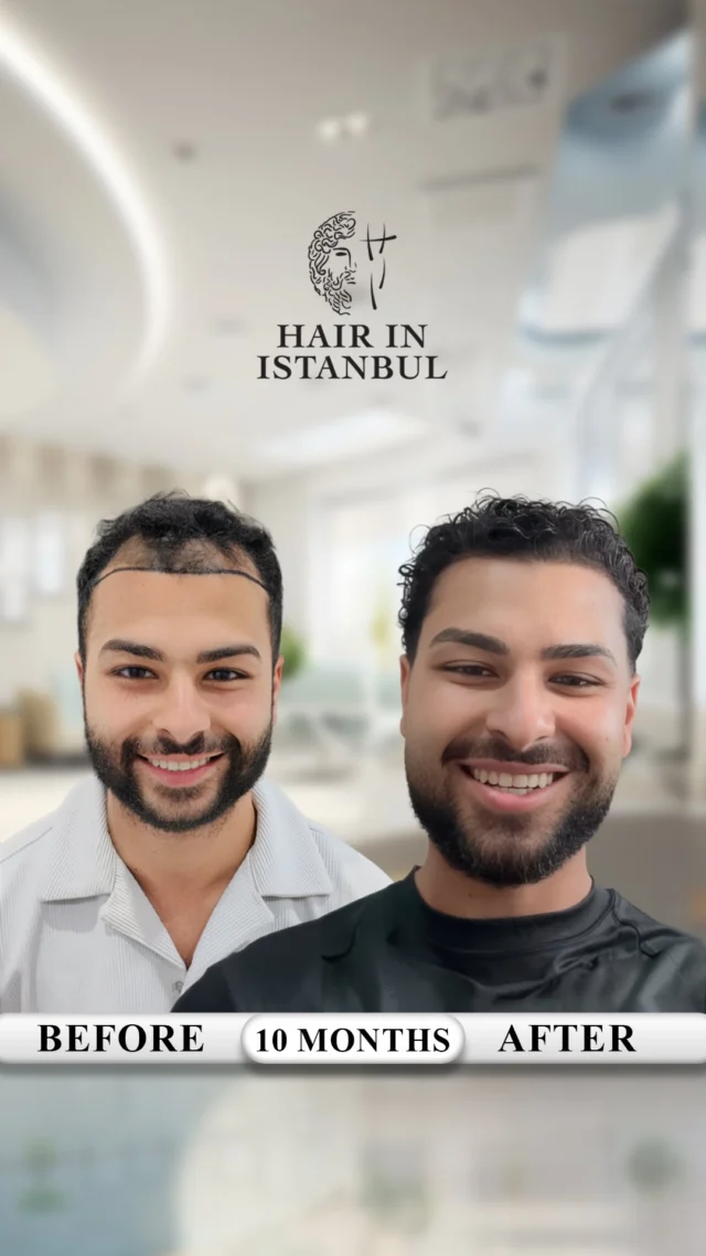 🎥 From Sydney, Australia to Istanbul – Results Speak, Not Distance 🇦🇺➡️🇹🇷

Haidar came from Sydney, Australia.
From the other side of the world.

Not because it was close.
Definitely not because it was cheap.

He came for one reason:

Results.

—

Everything started with a video.

He saw his friend’s transformation.
The hairline… the density… the natural look…

And in that moment, something clicked:

“If results like this exist… why am I still settling for less?”

—

This wasn’t curiosity.
This was a decision.

And that decision…
Brought him to Istanbul.

—

✨ Procedure Details

✔️ 4,300 grafts transplanted
✔️ Hairline redesigned from scratch
✔️ Mid-scalp filled with maximum density
✔️ Natural angles for undetectable results

The result?

No one says “you had a transplant.”
But everyone notices the difference.

—

🌍 Here’s the truth:

Australia has clinics.
The US has clinics.
Europe has plenty.

But people still travel here.

Why?

Because anyone can do a transplant…
But not everyone can deliver the right result.

—

💎 This is what makes us different:

✔️ No copy-paste hairlines
✔️ No artificial look
✔️ No weak density

✔️ Fully customized design
✔️ Maximum density
✔️ Natural, undetectable results

—

📊 2025 data: 52% of our patients come through referrals.

That means:

People don’t come because of ads…
They come because of results.

Because:

Great work speaks for itself.

—

🎥 And we don’t hide it.

❌ No Photoshop
❌ No filters

✔️ Real videos
✔️ Real people
✔️ Real results

—

🤝 We don’t just transplant hair.

We restore confidence.

From avoiding mirrors…
To owning your reflection again.

—

🔥 Let’s be honest:

If the result is average…
No one flies 15 hours.

But if the result looks like this…
People will travel across the world.

Haidar did.

Are you next, or still watching?

📩 DM us now. Let’s plan your transformation.

#HairTransplantTurkey
#HairInIstanbul
#FUESapphire
#HairlineDesign
#NaturalHairTransplant