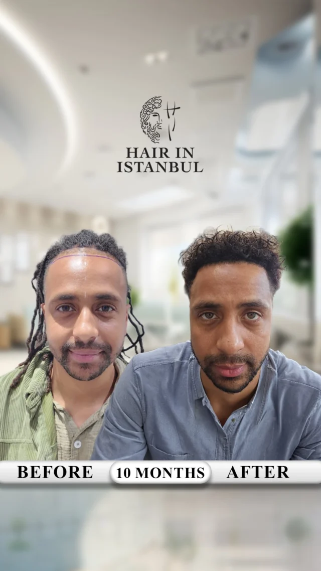🇬🇧 From the UK to Istanbul — Jamal’s Result 🇹🇷

This is Jamal.
He didn’t come here to “try.”
He came here to get it done **properly.**

And that’s exactly what we did.

In a single session:

✔️ Hairline rebuilt with precision
✔️ Mid-scalp packed for density
✔️ Crown fully covered
✔️ **100% unshaven procedure** — zero shaving, zero compromise

All completed with **3,800 grafts.**

But let’s be clear:
👉 Numbers don’t matter.
👉 Words don’t matter.

**Only what you SEE matters.**

—

Look at the video carefully.

This is not “decent.”
This is not “okay.”
This is **elite-level density.**

👉 Wall-like coverage
👉 Perfect transitions
👉 Natural hairline with ZERO artificial look

And the most important part?

👉 You’re watching this in VIDEO.

—

Let’s stop pretending for a second.

Today, the industry is full of illusions:

📸 Edited photos
📸 Fake angles
📸 AI-generated density
📸 Clinics hiding behind filters

Anyone can look “good” in pictures.

But video?

🎥 Video destroys lies.
🎥 Video shows reality.

And most clinics avoid it for a reason.

—

We don’t.

Because we have nothing to hide.

And we’re confident enough to say this openly:

👉 If you can find a better result than this —
✔️ Afro hair
✔️ Unshaven
✔️ Same or higher density
✔️ Proven clearly in VIDEO

**We will do your hair transplant COMPLETELY FREE.**

No excuses. No conditions.

—

Because this level?

👉 It’s rare.
👉 It’s difficult.
👉 And it’s NOT something every clinic can do.

—

So when you choose a clinic, ask yourself:

Are you choosing based on **hope**?
Or based on **proof**?

Because at the end of the day…

❌ Promises don’t grow hair
❌ Cheap offers don’t create density

✅ **Skill does.**
✅ **Experience does.**
✅ **REAL results do.**

—

🎥 Real patient
🎥 Real video
🎥 Real density
🎥 Real work

—

You don’t need 10 clinics.
You don’t need more confusion.

👉 You need ONE right decision.

—

📩 DM us now.
If you’re serious — we’re ready.

#afrohairtransplant
#afrohair
#afrohairline
#afrohairrestoration
#afrohairclinic