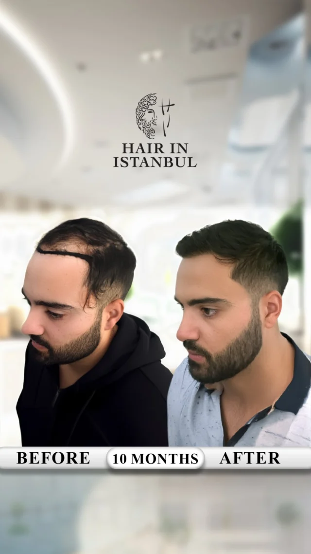 From Melbourne, Australia to Istanbul – Results Don’t Lie 🇦🇺➡️🇹🇷

Hakim came from Melbourne.
From the other side of the world.

Not because it was close.
Definitely not because it was cheap.

One reason only:
Real results.

—

Hakim had thinning and loss in the front, mid-scalp, and especially the crown area.

The part everyone fears:
The crown.

Because people keep saying:
“The crown doesn’t grow.”
“It’s the hardest area.”
“It usually fails.”

But is that actually true?

—

✨ Procedure Details

✔️ 5,400 grafts transplanted
✔️ Hairline redesigned from scratch
✔️ Mid-scalp filled with maximum density
✔️ Crown restored with strong, dense coverage
✔️ Existing hair strengthened and supported

—

Now here’s the key point:

When you watch this video, you’ll clearly see how successful the crown area is.

Dense.
Natural.
Balanced.

No excuses.
Just results.

—

This isn’t luck.

This is experience.
This is expertise.
This is proper planning.

—

🌍 Here’s the truth:

Australia has clinics.
Europe has clinics.
The US has clinics.

Yet people still travel here.

Why?

Because anyone can do a transplant…
But not everyone can deliver results.

—

💎 What makes us different:

❌ No copy-paste hairlines
❌ No artificial look
❌ No weak density

✔️ Fully customized design
✔️ Maximum density
✔️ Natural, undetectable results

—

🎥 And we don’t hide it:

❌ No Photoshop
❌ No filters

✔️ Real videos
✔️ Real patients
✔️ Real results

—

🤝 We don’t just transplant hair.

We change how you see yourself.

—

🔥 Let’s be honest:

If the result is average…
No one flies 15 hours.

But if it looks like this…
People travel.

Hakim did.

Are you still watching?

📩 DM us. Let’s plan your real transformation.
#HairTransplantTurkey
#HairInIstanbul
#FUESapphire
#HairlineDesign
#NaturalHairTransplant