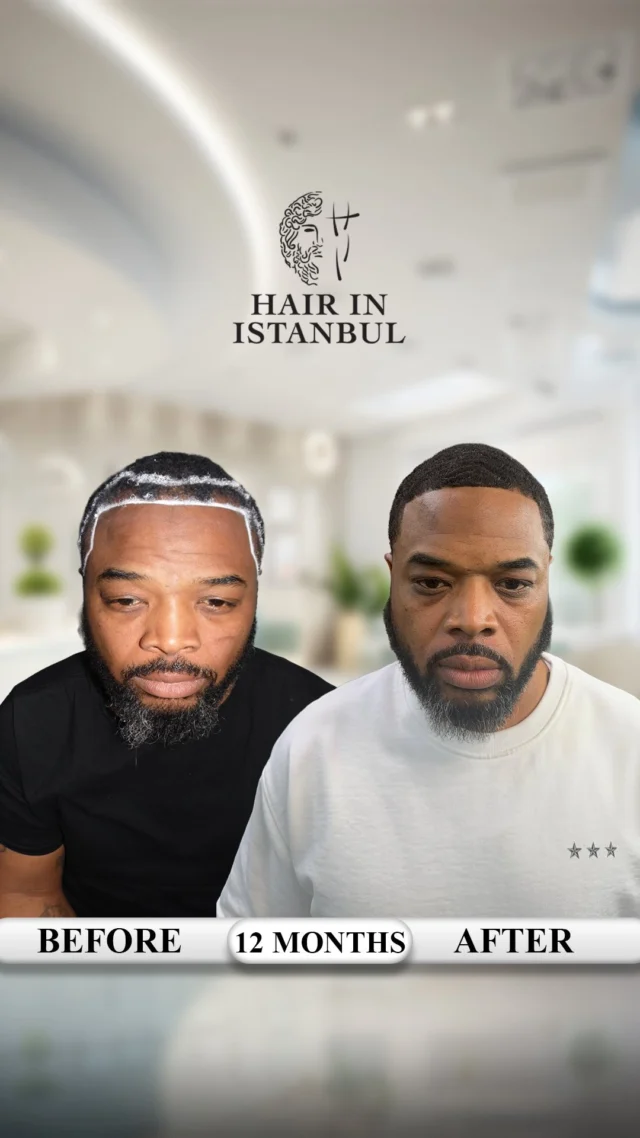 From the United States to Istanbul — Michael’s 12-Month Afro Hair Transplant Result 🇹🇷

This is Michael.

He came from the United States to Istanbul with one goal: to achieve a natural, strong, and complete hair transplant result.

Now, 12 months later, the real result is clearly visible on video.

Let’s be honest:

Photos can be edited.
Lighting can hide weak areas.
Angles can make density look different.
AI can create fake results.

But video does not lie.

This video was not recorded as a professional clinic shoot. It was recorded live at the barber, with real lighting, real movement, real density, and a real result.

For Michael, we worked on:

✔️ Frontal hairline
✔️ Right temple
✔️ Left temple
✔️ Mid-scalp density
✔️ Crown / vertex area

And yes, the crown area was also transplanted.

Some people, clinics, or organizations say the crown area cannot be done properly, especially in Afro hair cases.

But here, you can see the result clearly.

The crown area was transplanted, the density is visible, and the result looks natural.

Afro hair transplantation is not a simple procedure. The curly structure continues under the skin, so the extraction angle, channel direction, implantation angle, and density planning must be done with extreme precision.

One wrong angle can create an unnatural result.
One wrong plan can weaken the density.

That is why experience matters.

We don’t like to talk too much.
We prefer to show.

Because in hair transplantation, the one who truly earns trust is not the one who talks the most, but the one who can show real results.

No Photoshop.
No filters.
No fake promises.

Just a real patient, a real barber video, and a real 12-month Afro hair transplant result.

🎥 Watch the video carefully.
The hairline, temples, crown area, and natural movement already tell the whole story.

📩 DM us for your personalized hair analysis and treatment plan.

Our operations are carried out at contracted medical institutions.

#hairtransplant
#afrohairtransplant
#afro
#hairtransplantturkey
#hairinistanbul