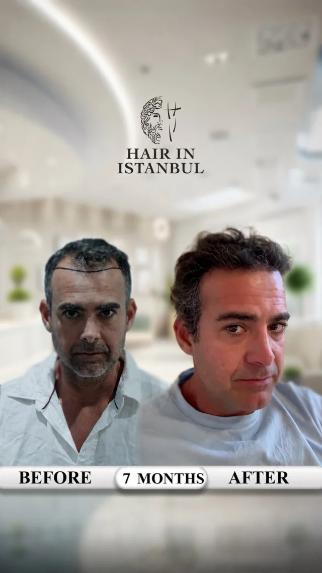 From Australia to Istanbul – Bruno’s 7-Month Hair Transplant Transformation 🇦🇺➡️🇹🇷

No Photoshop.
No filters.
No fake promises.

Just a real patient, a real video, and a real 7-month hair transplant result.

Seven months ago, Bruno traveled from Australia to Istanbul with one goal: to restore a natural, stronger, and more confident look.

At Hair in Istanbul, we focused on rebuilding his frontal hairline and increasing density in the front area. He also had visible thinning in the crown area, so we carefully worked on that region as well to create better overall coverage.

With a personalized treatment plan and carefully placed grafts, we aimed for a result that looks natural, balanced, and suitable for his facial structure.

Only 7 months later, the improvement is already clearly visible — and his result will continue to get even better over the coming months.

Watch the video carefully.
His new hairline, crown coverage, natural density, and overall transformation already tell the whole story.

Real lighting.
Real angles.
Real result.

Why do patients from all around the world choose Hair in Istanbul?

✔️ Natural hairline design tailored to each patient
✔️ Crown and density restoration for a balanced result
✔️ Pro Plus PRP treatment to support healing and hair strength
✔️ VIP journey in Istanbul with airport transfer, hotel accommodation, and full assistance
✔️ Lifetime guarantee for long-lasting confidence

Bruno came from Australia, trusted the process, and now his transformation speaks for itself.

📩 DM us now for your free consultation.
Your hair transformation can start today.

Our operations are carried out at contracted medical institutions.

#HairTransplant #HairTransplantTurkey #HairInIstanbul #HairRestoration #HairlineTransformation CrownHairTransplant AustraliaToIstanbul NaturalHairline HairTransplantResults BeforeAfterHairTransplant