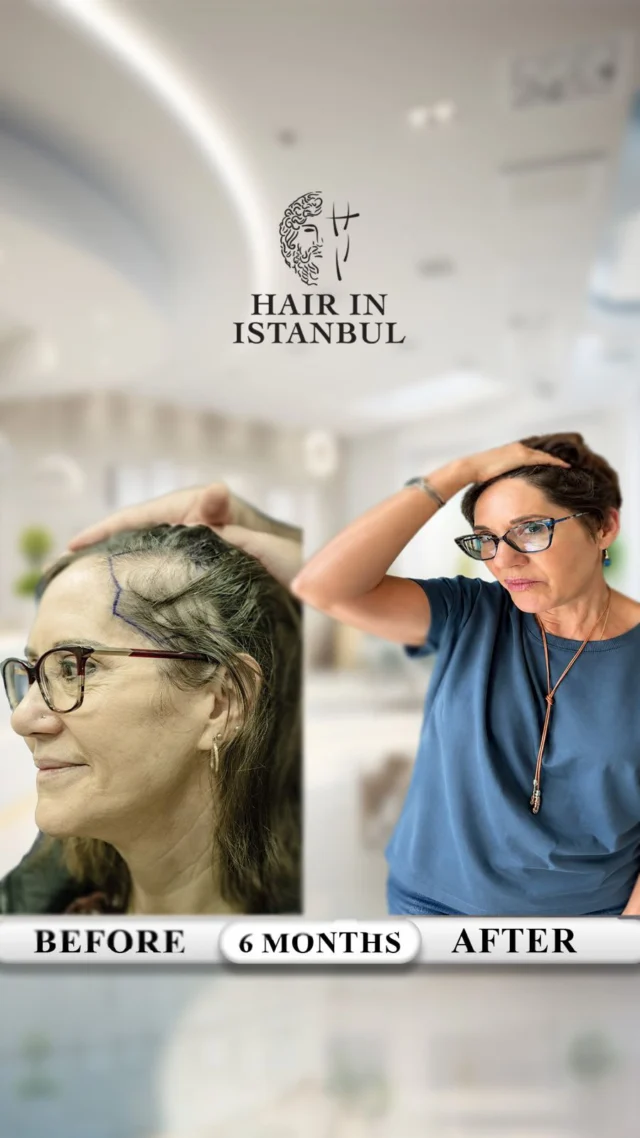 From USA to Istanbul – Colleen’s 6-Month DHI Hair Transplant Transformation 🇺🇸➡️🇹🇷

No Photoshop.
No filters.
No fake promises.

Just a real patient, a real video, and a real 6-month hair transplant result.

Six months ago, Colleen traveled from the USA to Istanbul to achieve a fuller, softer, and more natural look without shaving her hair.

At Hair in Istanbul, we performed a no-shave DHI hair transplant with 3,500 grafts using the pen technique. For female patients, the right and left temple areas are especially important because they frame the face and create a more balanced, feminine appearance.

For Colleen, we carefully filled both temple areas and also closed the openness in the frontal area. Our goal was to improve density while keeping the result natural and suitable for her facial structure.

With the DHI technique, grafts were placed between her existing hair with precision, controlling the angle, direction, and density for a soft and natural result.

Only 6 months later, the improvement is already clearly visible — and her hair will continue to become stronger and fuller in the coming months.

Watch the video carefully.
Her temple restoration, frontal density, natural hairline, and overall transformation tell the whole story.

Real lighting.
Real angles.
Real result.

Why do female patients choose Hair in Istanbul?

✔️ No-shave DHI hair transplant
✔️ Natural temple and hairline design
✔️ 3,500 grafts placed with precision
✔️ Frontal density restoration
✔️ VIP journey in Istanbul with airport transfer, hotel accommodation, and full assistance
✔️ Lifetime guarantee for long-lasting confidence

Colleen came from the USA, trusted the process, and now her 6-month transformation speaks for itself.

📩 DM us now for your free consultation.
Your hair transformation can start today.

Our operations are carried out at contracted medical institutions.

#FemaleHairTransplant
#DHIHairTransplant
#NoShaveHairTransplant
#HairTransplantTurkey
#HairInIstanbul