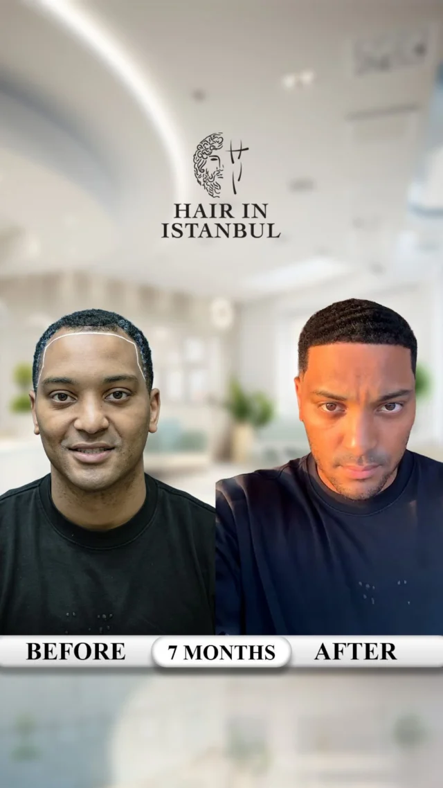 From New York to Istanbul — Marwing’s 7-Month Afro Hair Transplant Result 🇺🇸🇹🇷

This is Marwing.

He traveled from New York to Istanbul for a dense, strong, and completely natural-looking result.

Only 7 months later, you can see the transformation in this real barber video.

For Marwing, we restored:

✔️ The frontal hairline
✔️ The right temple
✔️ The left temple
✔️ The crown / vertex area

Look closely at the hairline.

You can see how naturally it blends with his face, how smoothly the temples connect, and how dense the transplanted hair already looks.

The most important part of a hair transplant is not simply creating a hairline or making the hair grow. The real success is creating a result so natural that nobody can tell a procedure was performed.

A successful hairline should not look transplanted. It should look as though it has always belonged to the patient — as if this were the hairline he was born with.

Just a soft, dense, age-appropriate hairline that looks authentic from every angle.

This is only the 7-month result, and his hair will continue to mature and thicken.

Afro hair transplantation requires experience because Afro follicles remain curved beneath the skin.

The extraction angle, implantation direction, temple design, crown placement, and density planning must be customized to the patient’s curl structure.

A small mistake can make the result look artificial. Correct planning can make it look like he never experienced hair loss.

🎥 Watch the video and listen to Marwing describe his satisfaction in his own words.

His confidence, natural movement, and visible density tell the real story.

The goal is not to give someone “transplanted hair.” The goal is to give them back hair that looks entirely their own.

📩 DM us for your personalized Afro hair analysis and treatment plan.

Our operations are carried out at contracted medical institutions.

#AfroHairTransplant #HairTransplantTurkey #NaturalHairline #HairTransplantIstanbul #HairInIstanbul