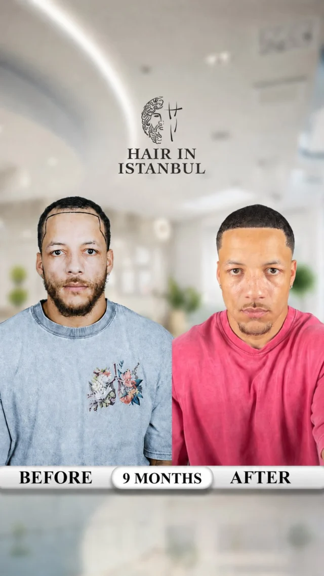 From Philadelphia, Pennsylvania to Istanbul — Will’s 9-Month Afro Hair Transplant Result 🇺🇸🇹🇷

This is Will.

He came to us from Philadelphia after seeing the result of a friend we had previously treated. Will loved how natural his friend’s hairline looked, and that recommendation gave him the confidence to begin his own journey with us.

You may remember Will from the video filmed when he first came to Istanbul. That video reached more than 1.5 million views, and thousands of people were waiting to see his transformation.

Now, only 9 months later, the result is here.

For Will, we created:

✔️ A strong, masculine box hairline
✔️ A new right temple line
✔️ A new left temple line
✔️ Natural density and balanced framing

What makes this result even more meaningful is that Will is a professional barber. He understands hairlines, symmetry, blending, angles, and the importance of looking natural from every direction.

From the beginning, he knew exactly what he wanted: a sharp but realistic hairline, clean temple restoration, and a result that would never look artificial.

Today, he can see in his own hair the same quality he once admired in his friend’s result.

We do not speak only with promises. We speak through real patients, real videos, and real results.

Photos can be edited and angles can be chosen, but a live barber video shows everything: the hairline, density, movement, temple connection, and how naturally the hair blends with the face.

🎥 Watch this video with the sound on and listen to Will explain his experience in his own words.

The video speaks for itself.

Only 9 months have passed, and his hair can continue to mature and become even stronger.

We do not simply create transplanted hair. We create hair that looks like it has always belonged to you.

📩 DM us for your personalized Afro hair analysis and treatment plan.

Our operations are carried out at contracted medical institutions.

#AfroHairTransplant #BoxHairline #NaturalHairline #HairInIstanbul