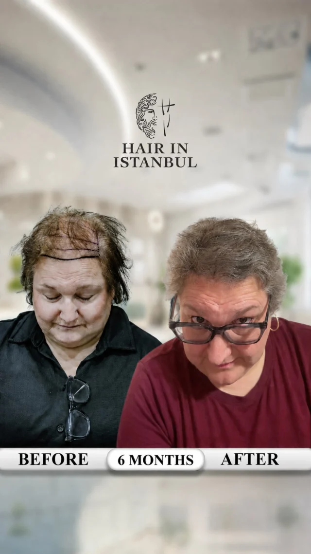 From Canada to Istanbul — Dina’s DHI Hair Transplant Transformation 🇨🇦➡️🇹🇷

No Photoshop. No filters. No fake promises.

Just a real patient, a real video, and a result that surprised even Dina herself.

Dina traveled from Canada to Istanbul at the age of 56 to restore the density she had lost and feel confident with her hair again.

At Hair in Istanbul, we performed a DHI hair transplant using approximately 4,200 grafts. Each graft was implanted with careful control of its angle, direction, depth, and distribution to create a dense yet natural appearance.

Why did we use such a high number of grafts?

Because Dina’s hair strands were naturally very fine. With fine hair, visible density requires precise placement, balanced distribution, and careful protection of the existing hair and donor area.

Now, look closely at the result.

Her transplanted hair appears soft, dense, and natural. The transition between her existing hair and the transplanted area is smooth and difficult to detect.

Her donor area also remains healthy and balanced, with no obvious gaps or signs of overharvesting.

A successful hair transplant is not only about graft numbers. It is about knowing how many grafts can be taken safely, where they should be placed, and how to create density without damaging the donor area.

Female hair transplantation requires special expertise because fine hair, diffuse thinning, and existing hair must all be considered and protected.

Many clinics avoid challenging female cases. At Hair in Istanbul, we approach them with precision, experience, and personalized planning.

Dina trusted the process, and today, even she is amazed by the transformation.

Watch the video carefully. The density, natural appearance, and healthy donor area tell the whole story.

Some clinics search for easy cases. We specialize in creating solutions for challenging ones.

📩 Send us a message for your free consultation.

Our procedures are carried out at contracted medical institutions.

#FemaleHairTransplant #DHIHairTransplant #HairTransplantTurkey #NaturalHairTransplant #HairInIstanbul